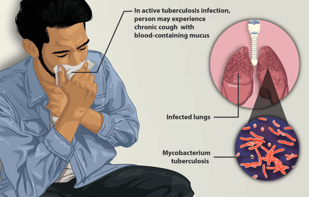 Harris County tops Texas and US in active tuberculosis cases